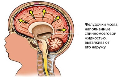 Гидроцефалия плода