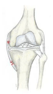 Разрыв/растяжение медиальной коллатеральной связки (внутренней боковой связки)