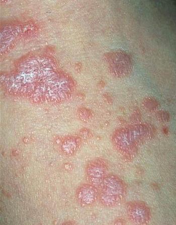 Красный плоский лишай