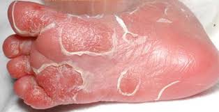 Пузырчатка новорожденных