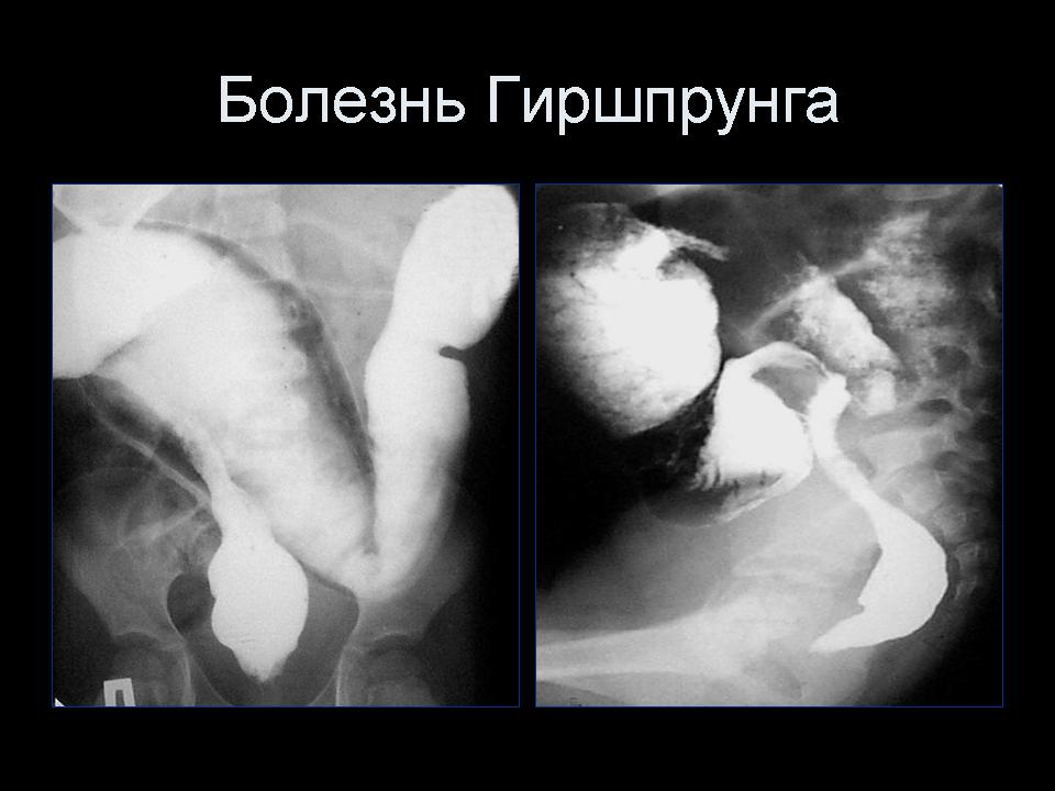 Болезнь Гиршпрунга