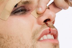 Травмы носа