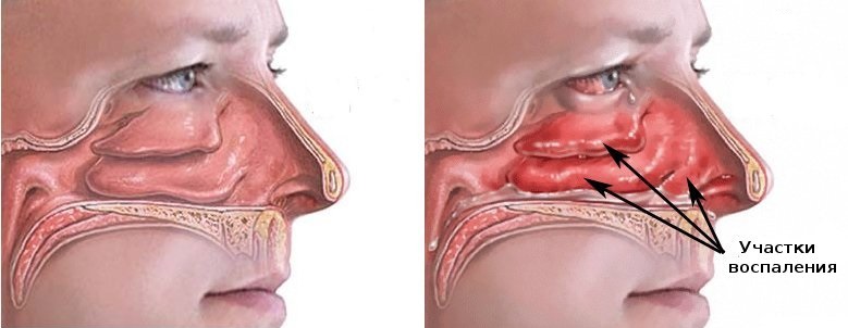 Вазомоторный ринит