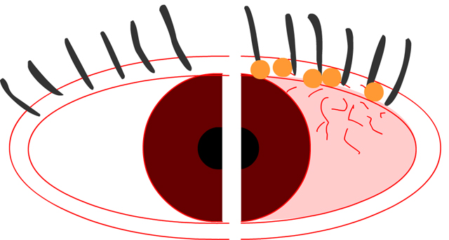 Воспаление века (блефарит)