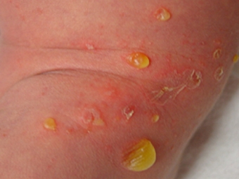 Пузырчатка новорожденных