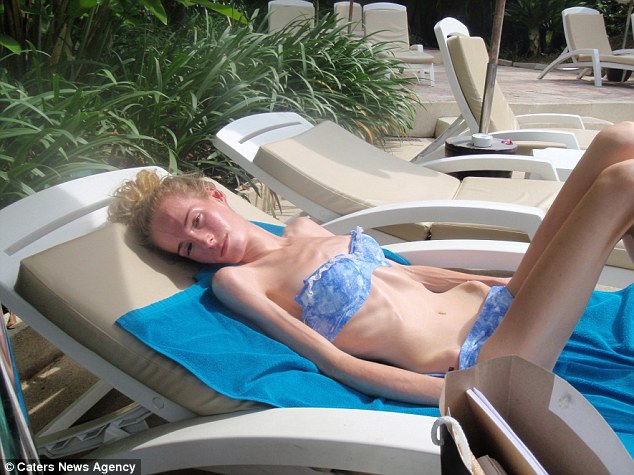 Девушка, которая весила 28 кг, показала свои фото в период анорексии