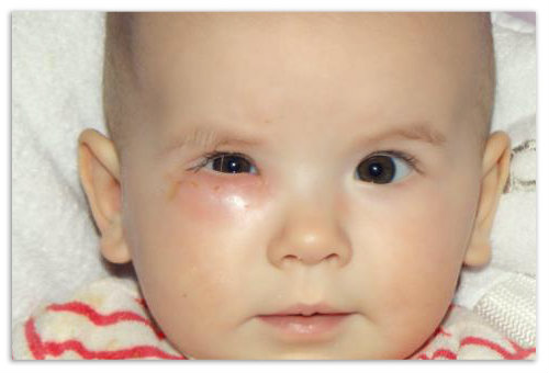 Дакриоцистит новорожденных