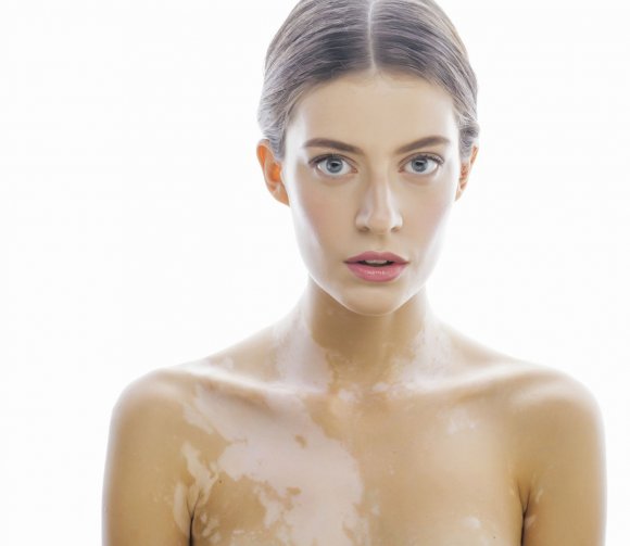 Витилиго: основные причины, сопутствующие симптомы, лечение