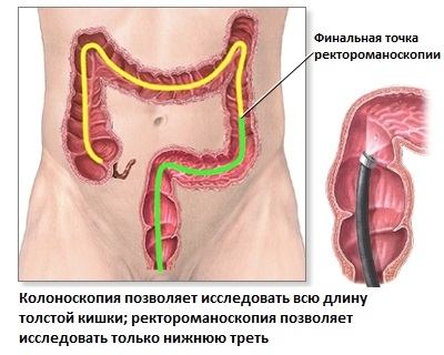 Рак толстой кишки