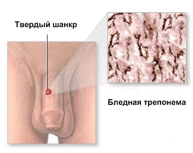 Первичный сифилис