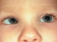 У 10% украинцев – скрытое косоглазие