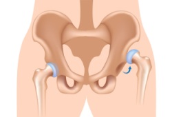 Вывих бедра