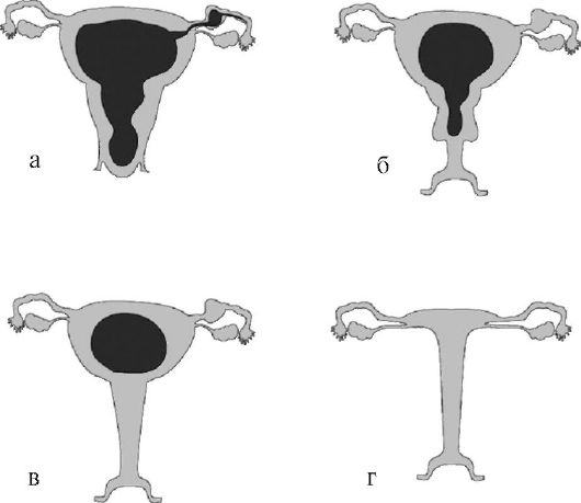 Атрезия влагалища