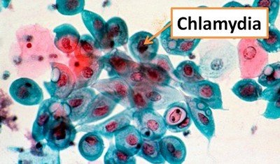 Хламидиоз