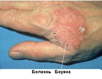 Болезнь Боуэна