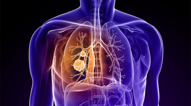 Туберкулема