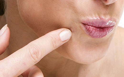 Выведение бородавок народными средствами