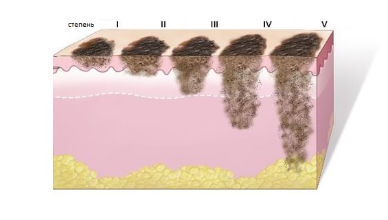 Карцинома кожи