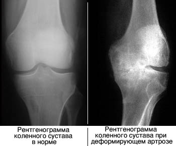 Деформирующий остеоартроз