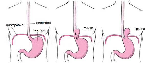 Грыжа пищевода