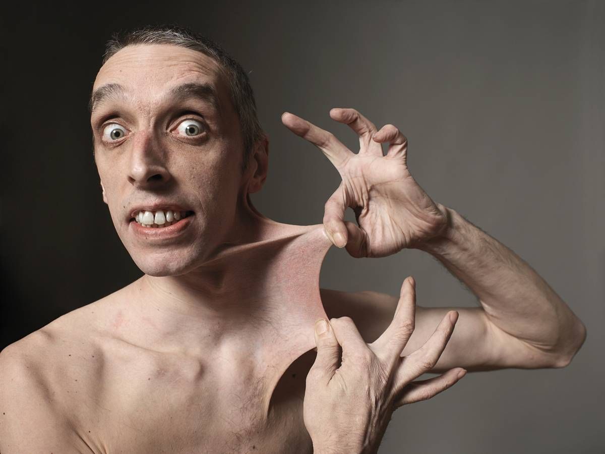 Синдром Элерса-Данлоса