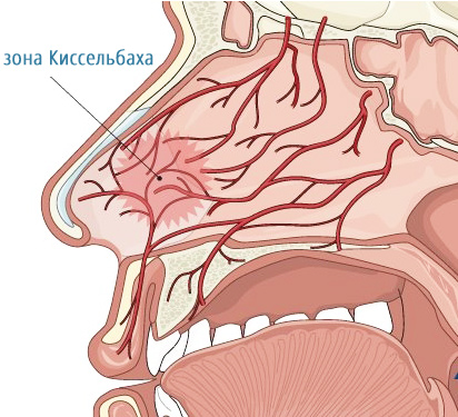 Носовое кровотечение