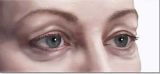 Блефарохалазис