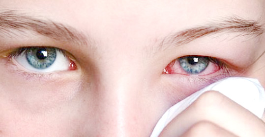 Синдром Кавасаки