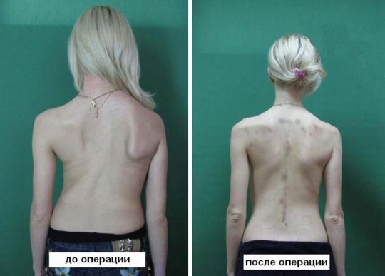 Методы лечения сколиоза. Что выбрать: корсет или операцию?