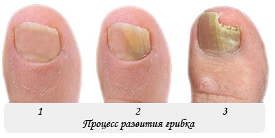 Онихомикоз (грибок ногтей)