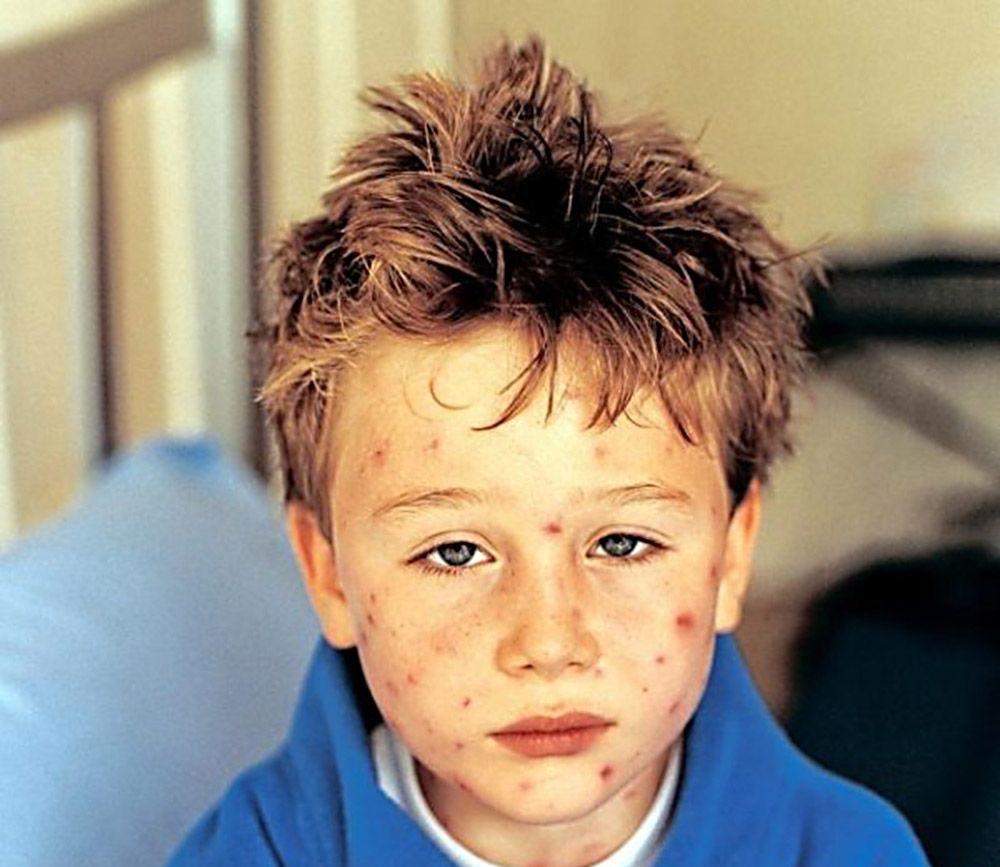 Риккетсиоз