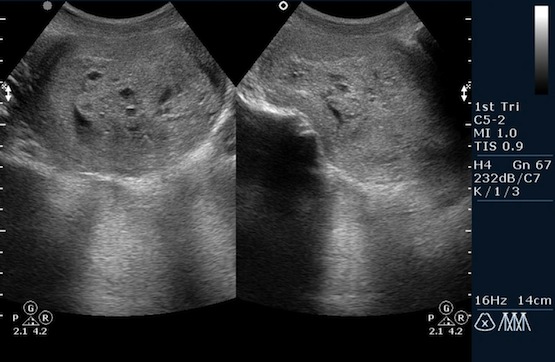 Трофобластическая болезнь