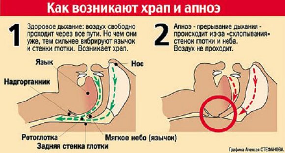 Что делать, если муж храпит? Современные методы лечения храпа