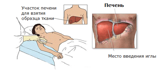 Цирроз печени