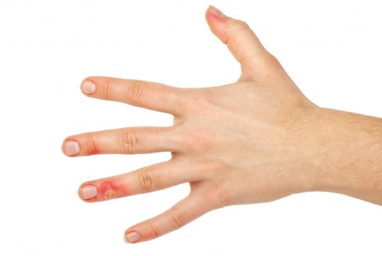 Можно ли прокалывать волдыри от ожога? Самые популярные вопросы об ожогах