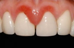 Перикоронарит - воспаление капюшона десны