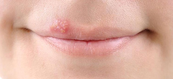 Герпес на губах