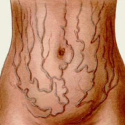 Цирроз печени