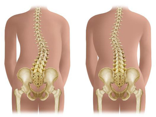 Кифосколиоз