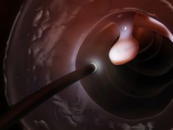 Удаление полипа прямой кишки