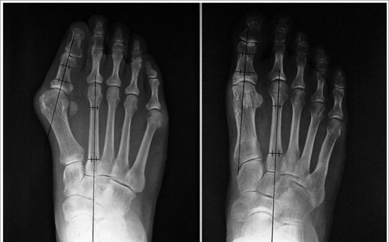 Вальгусная деформация