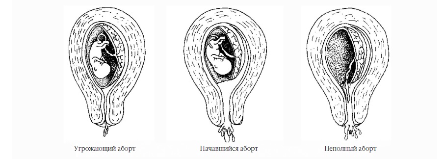 Угрожающий аборт