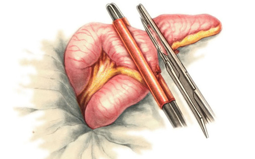 Меккелев дивертикул