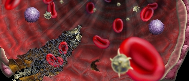 Антифосфолипидный синдром