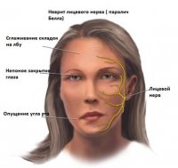 Невралгия тройничного нерва