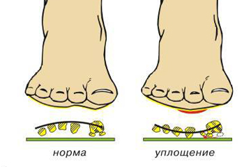Поперечное плоскостопие