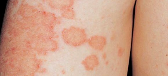 Нуммулярная экзема