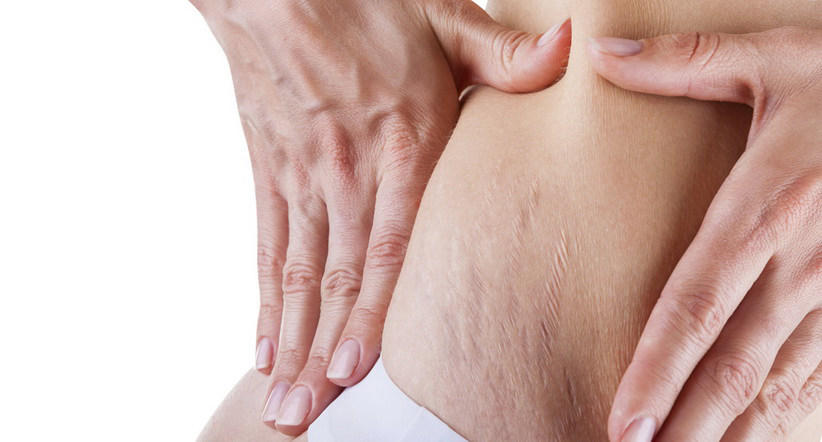 Растяжки (стрии)