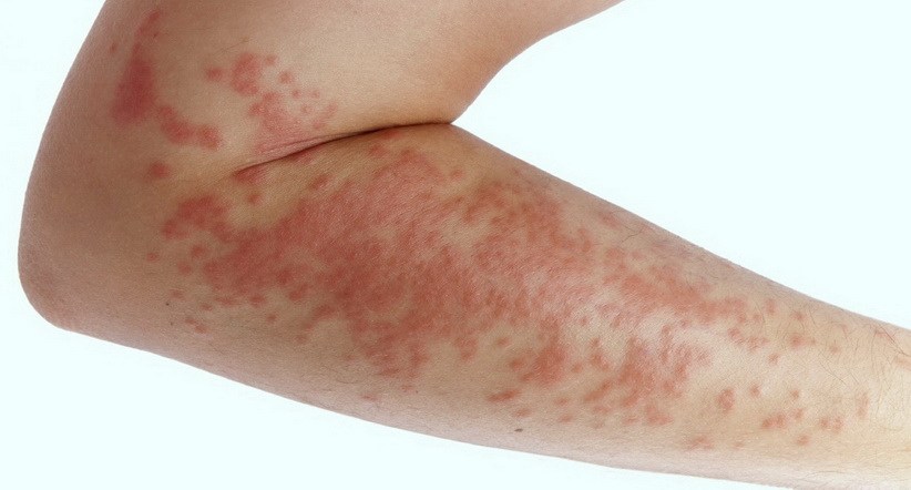 Сыпь (высыпания на коже)