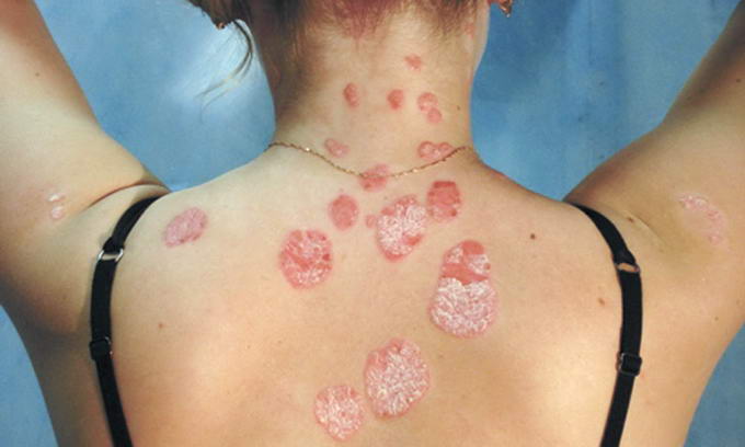Бляшки на коже